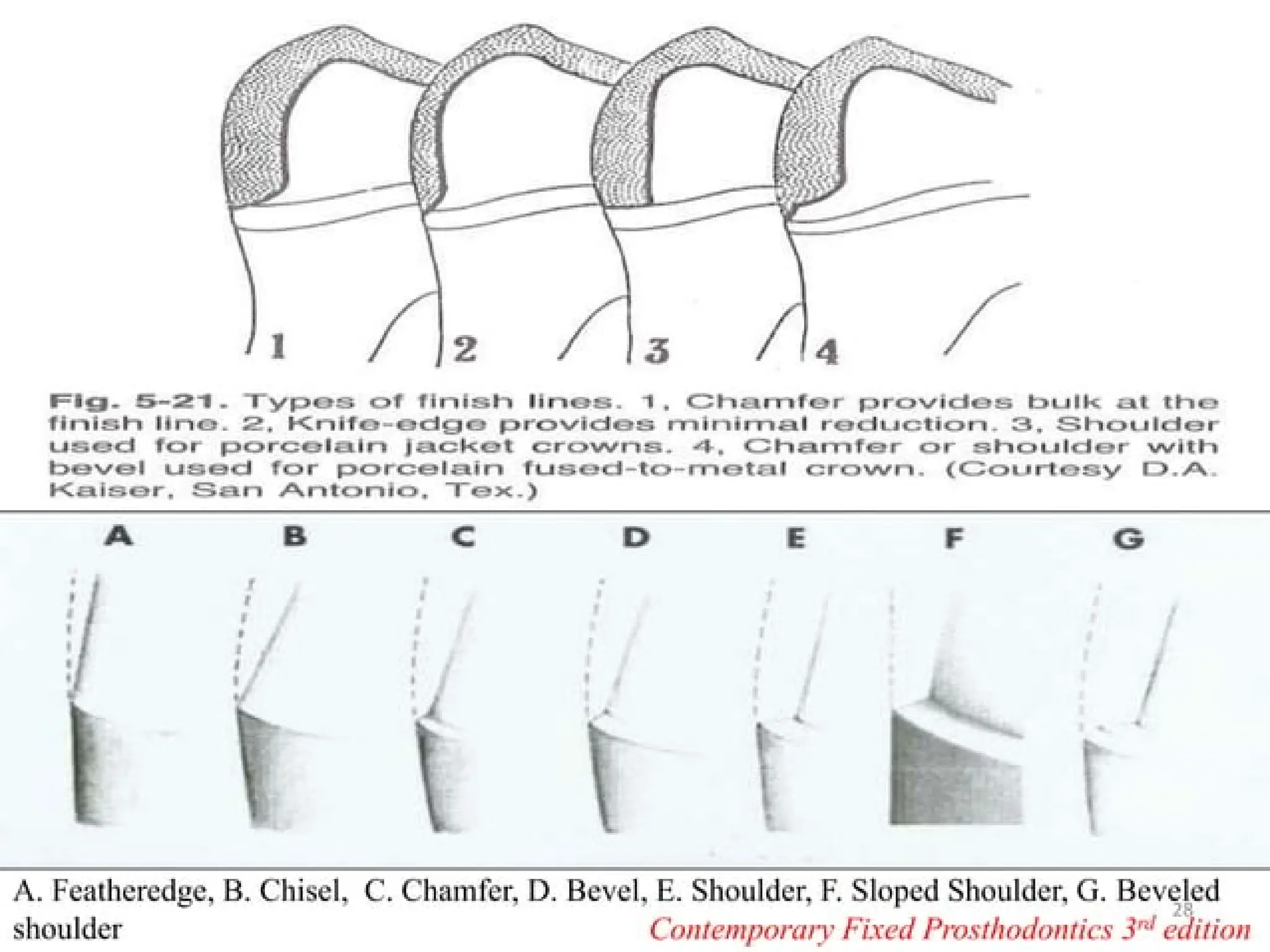 finish lines in fixed partial denture .pptx