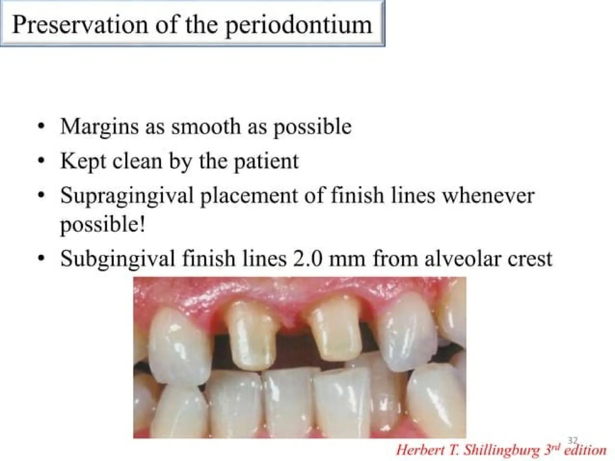 finish lines in fixed partial denture .pptx