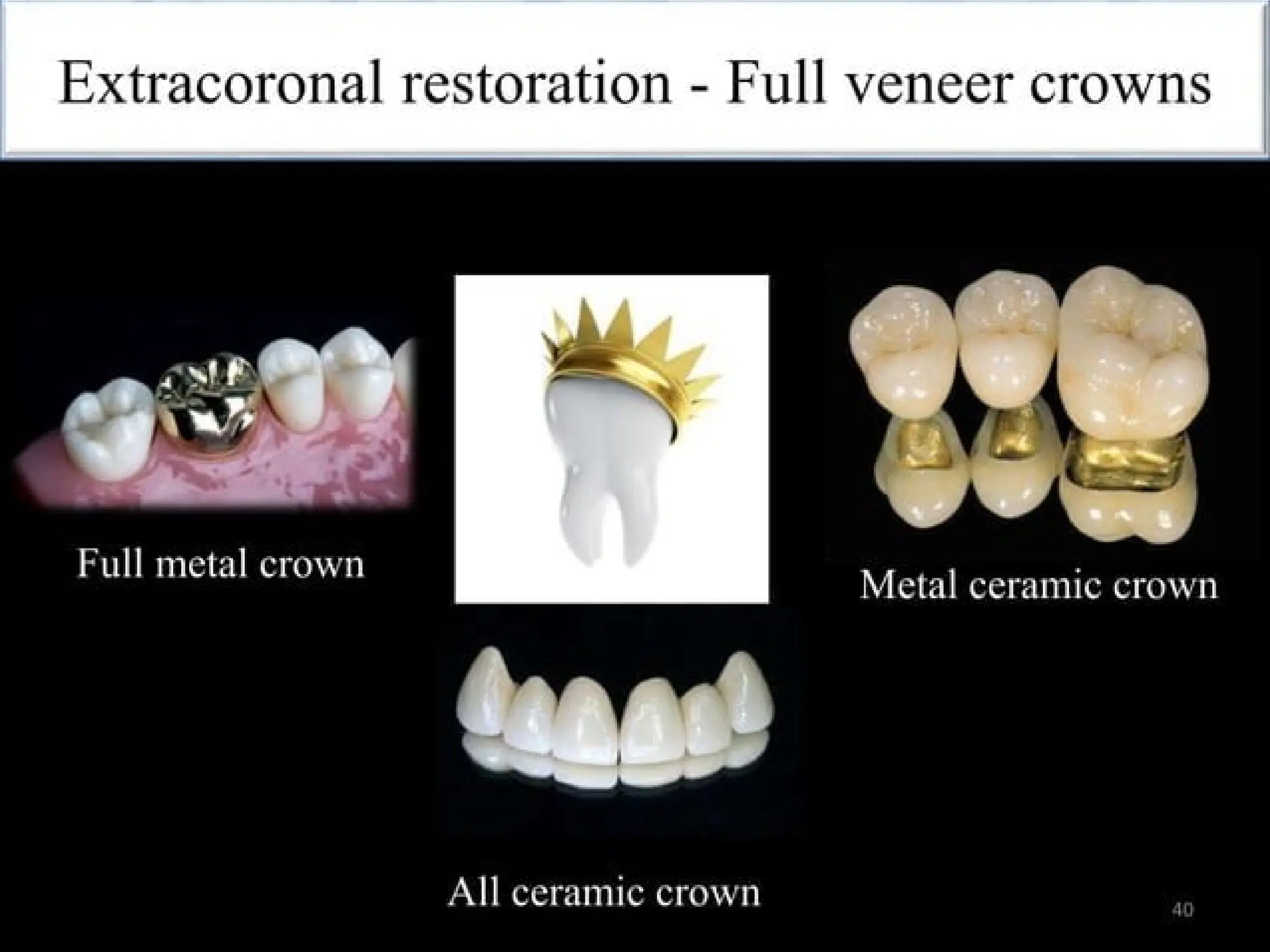 finish lines in fixed partial denture .pptx