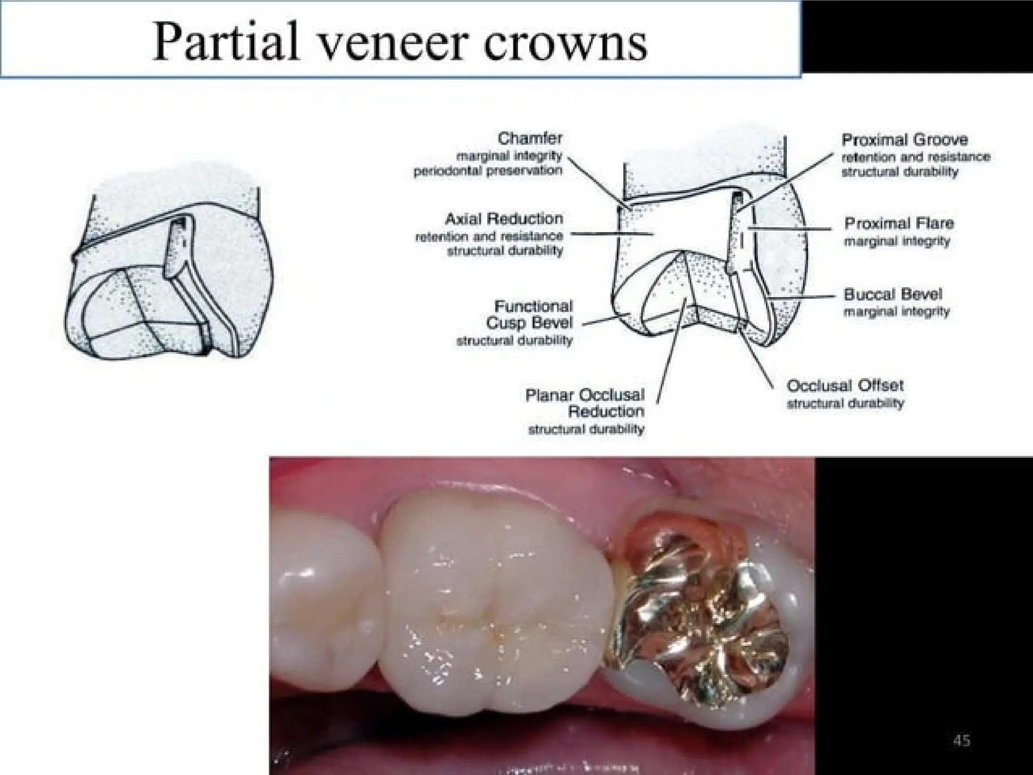 finish lines in fixed partial denture .pptx