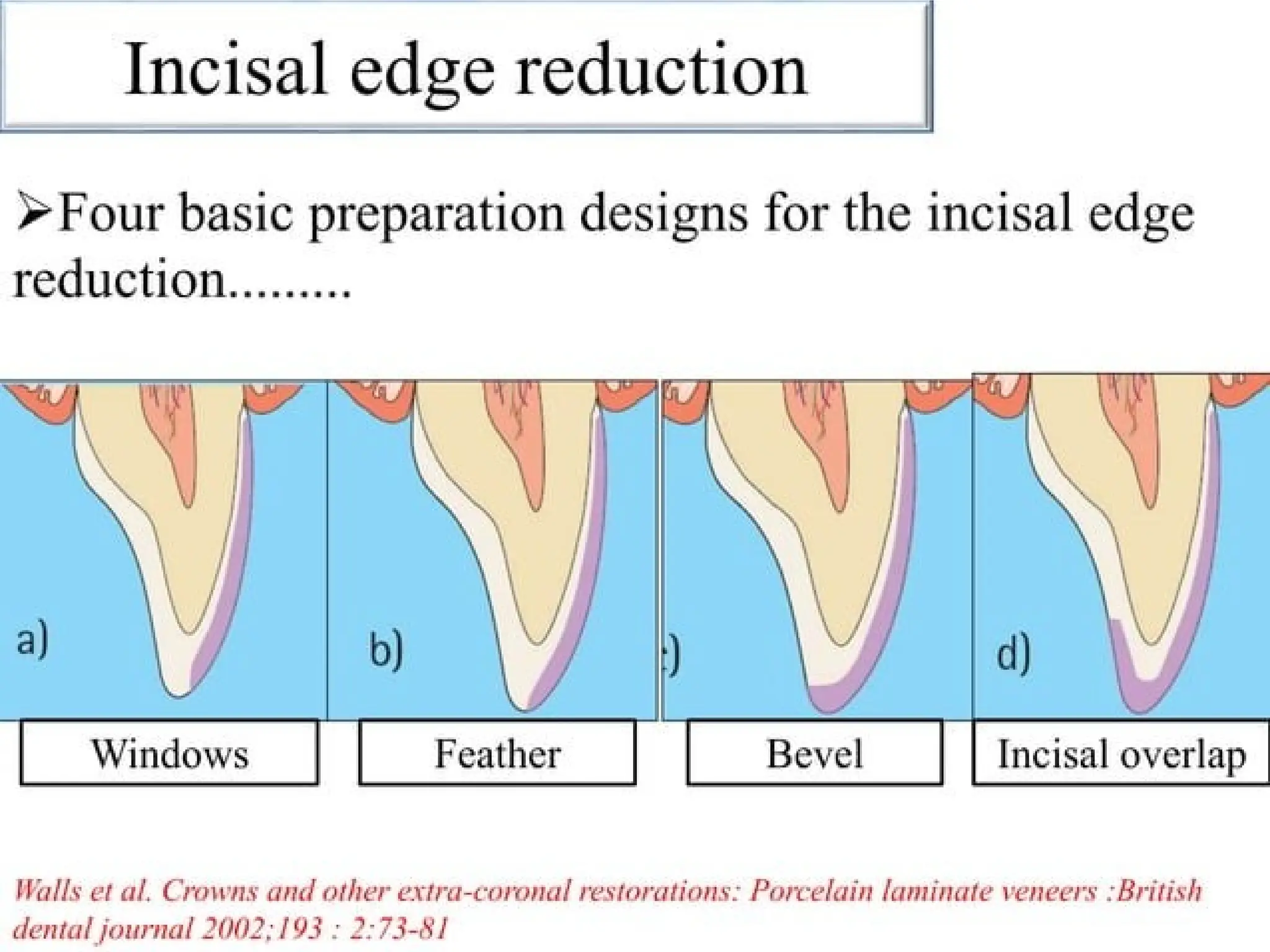 finish lines in fixed partial denture .pptx