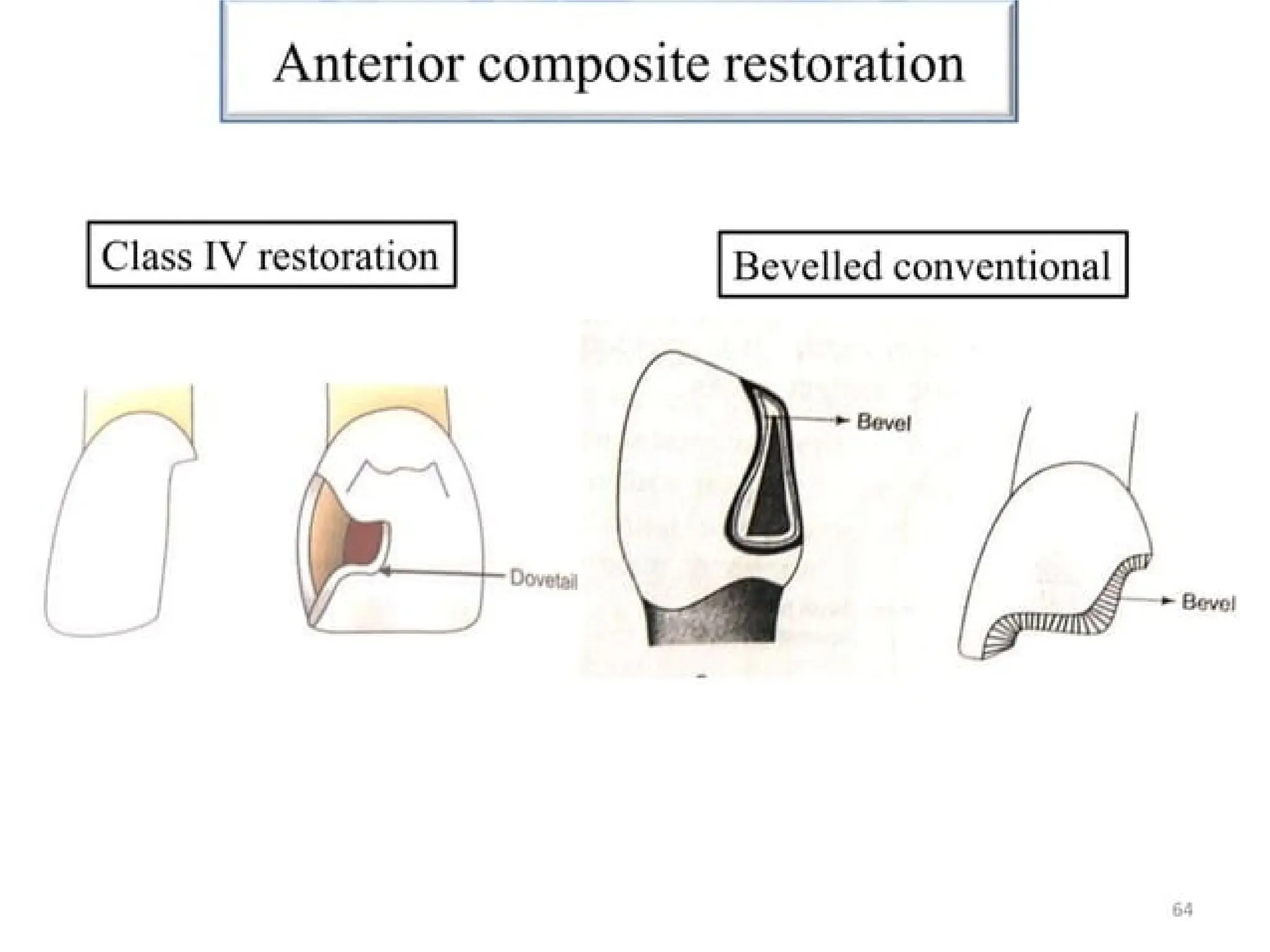 finish lines in fixed partial denture .pptx