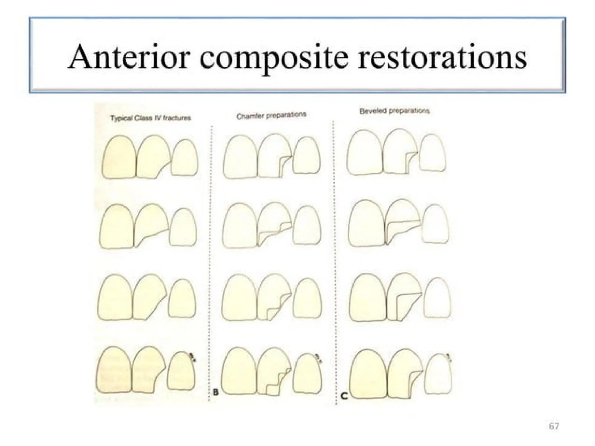 finish lines in fixed partial denture .pptx