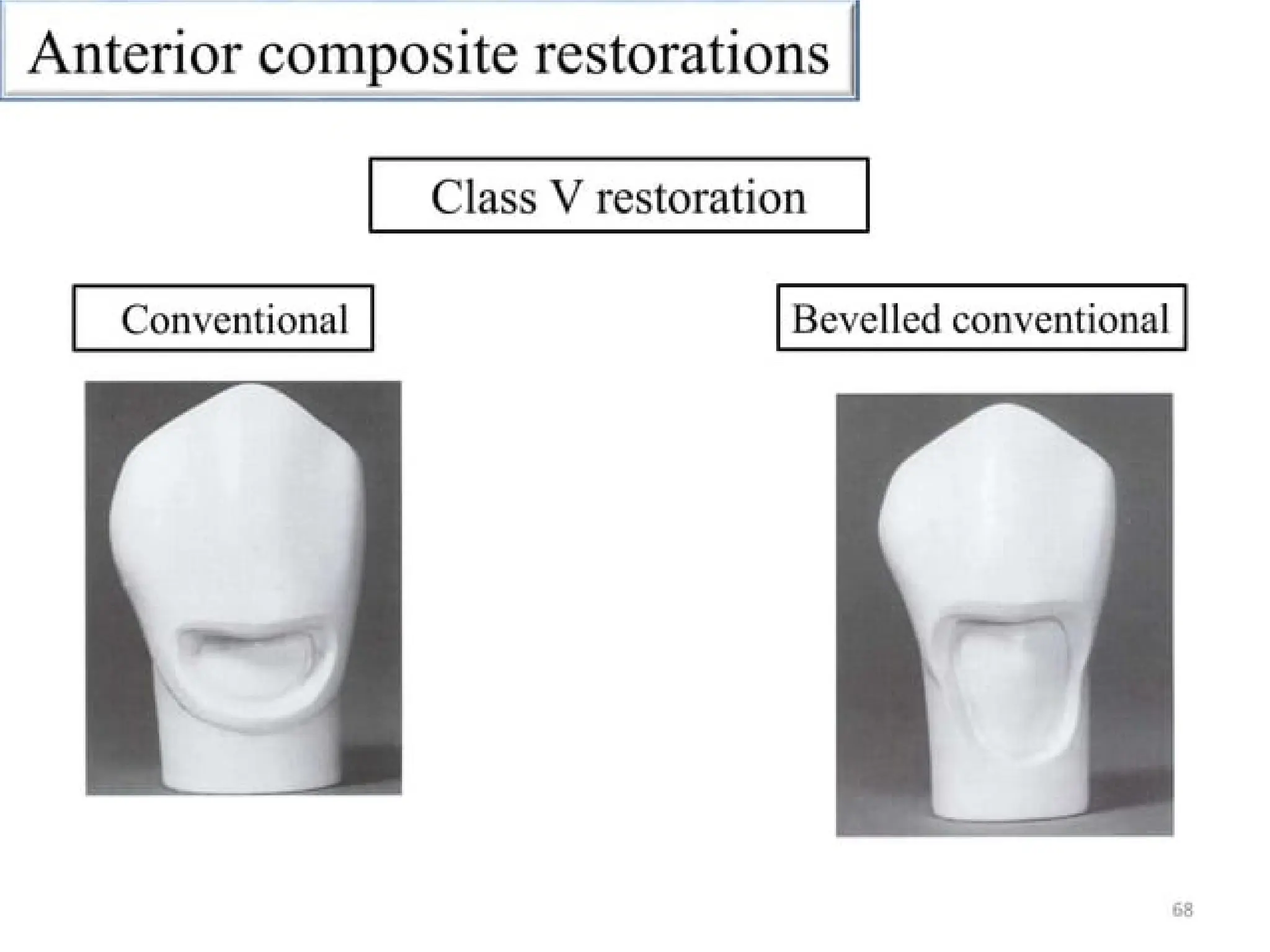 finish lines in fixed partial denture .pptx