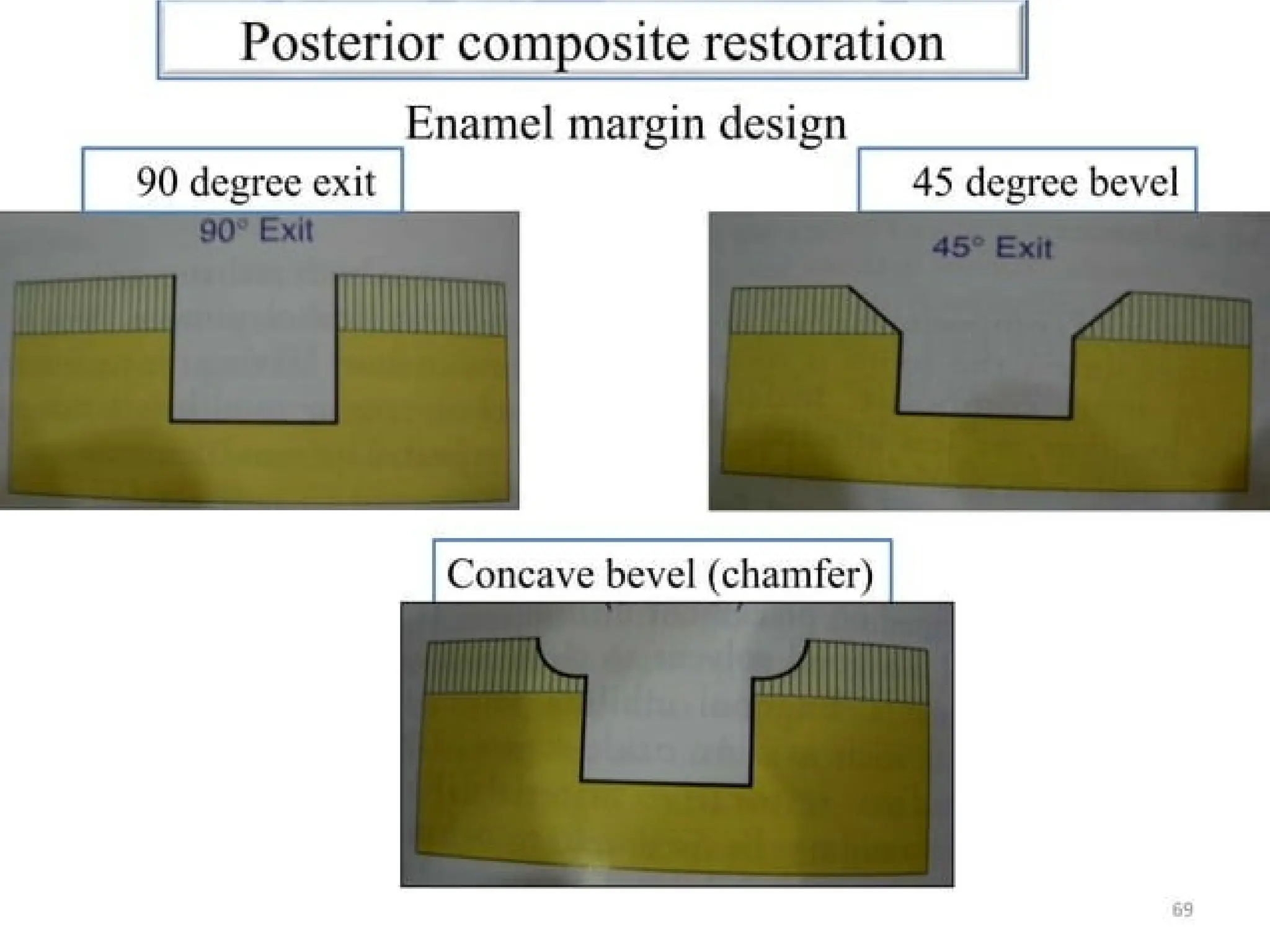 finish lines in fixed partial denture .pptx