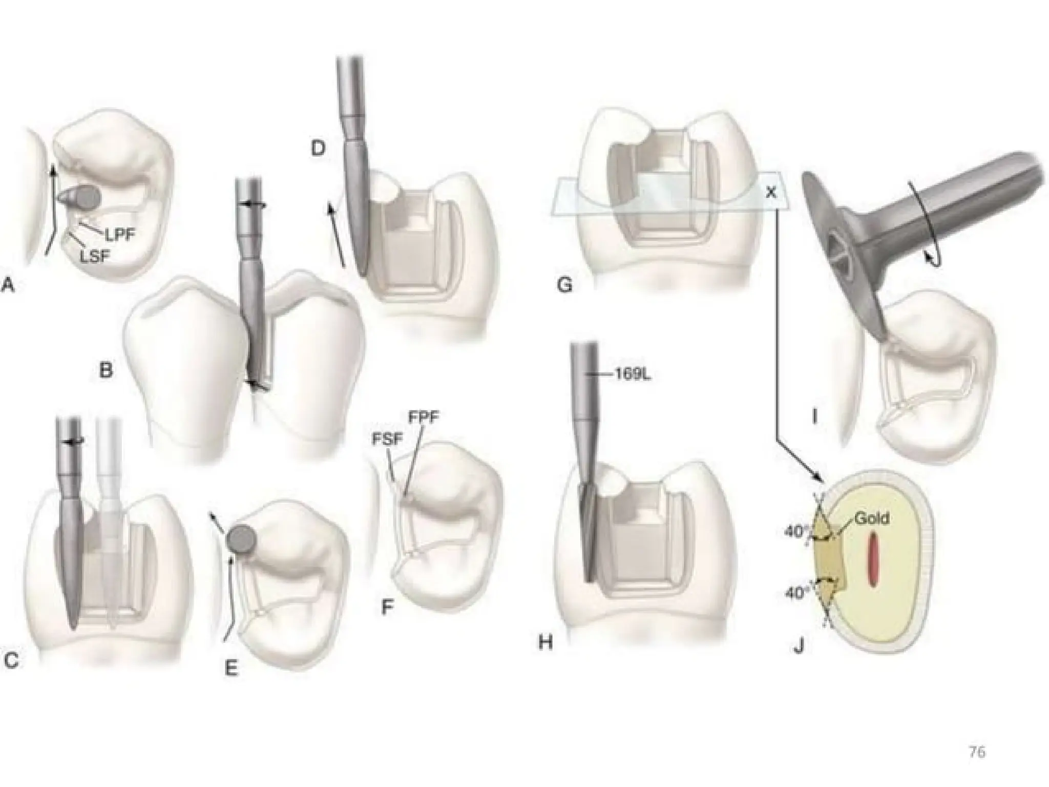 finish lines in fixed partial denture .pptx