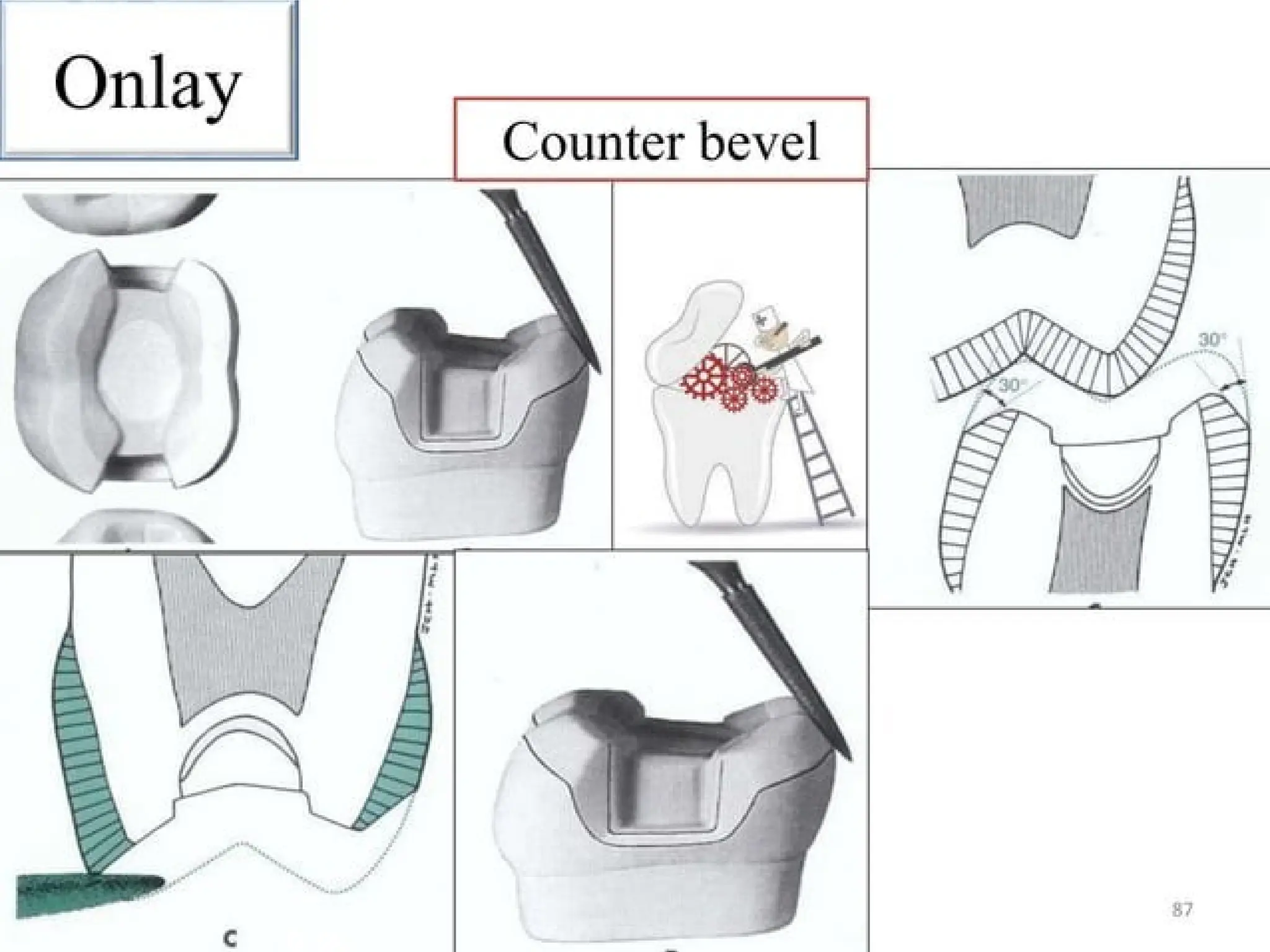 finish lines in fixed partial denture .pptx