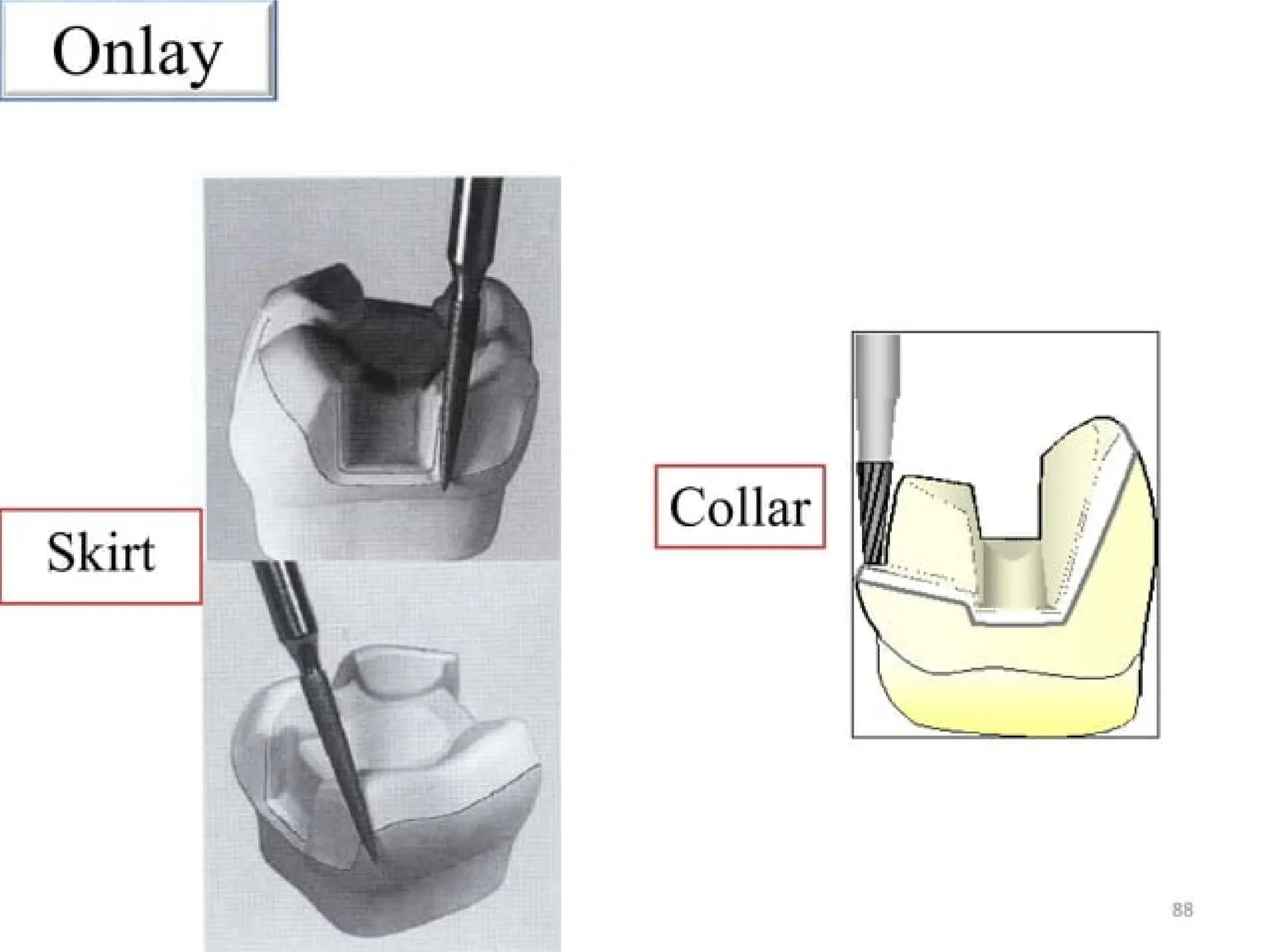 finish lines in fixed partial denture .pptx