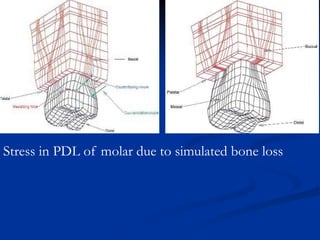Stress in PDL of molar due to simulated bone loss
 