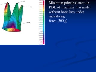 Minimum principal stress in
PDL of maxillary first molar
without bone loss under
mesializing
force (300 g)
 