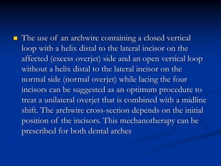  The use of an archwire containing a closed vertical
loop with a helix distal to the lateral incisor on the
affected (excess overjet) side and an open vertical loop
without a helix distal to the lateral incisor on the
normal side (normal overjet) while lacing the four
incisors can be suggested as an optimum procedure to
treat a unilateral overjet that is combined with a midline
shift. The archwire cross-section depends on the initial
position of the incisors. This mechanotherapy can be
prescribed for both dental arches
 