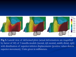 Fig 3. Lateral view of deformed plots (actual deformations are magnified
by factor of 60) of 3 maxilla models (mesial, left; neutral, middle; distal, right)
with distribution of superior-inferior displacements (positive values denote
superior movement). Units given in millimeters.
 