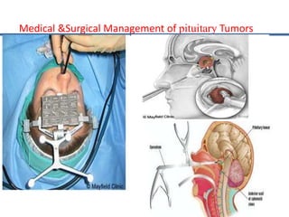Medical &Surgical Management of pituitary Tumors
 