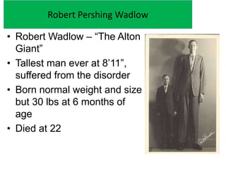 Robert Pershing Wadlow
• Robert Wadlow – “The Alton
Giant”
• Tallest man ever at 8’11”,
suffered from the disorder
• Born ...