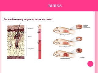 Do you how many degree of burns are there?
BURNS
 