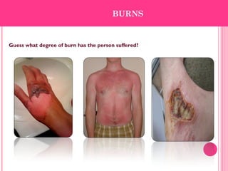 Guess what degree of burn has the person suffered?
BURNS
 