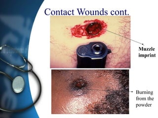 Contact Wounds cont.
Muzzle
imprint
Burning
from the
powder
 