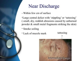 Near Discharge
- Within few cm of surface
-Large central defect with ‘stippling’ or ‘tattooing’
( small, dry, reddish abrasions caused by unburned
powder & small metal fragments striking the skin)
- Smoke soiling
- Lack of muzzle mark tattooing
Intermediate Range
 