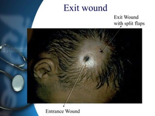 Exit wound
Entrance Wound
Exit Wound
with split flaps
 