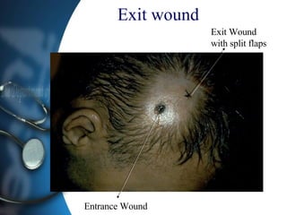 Exit wound   Entrance Wound Exit Wound with split flaps 