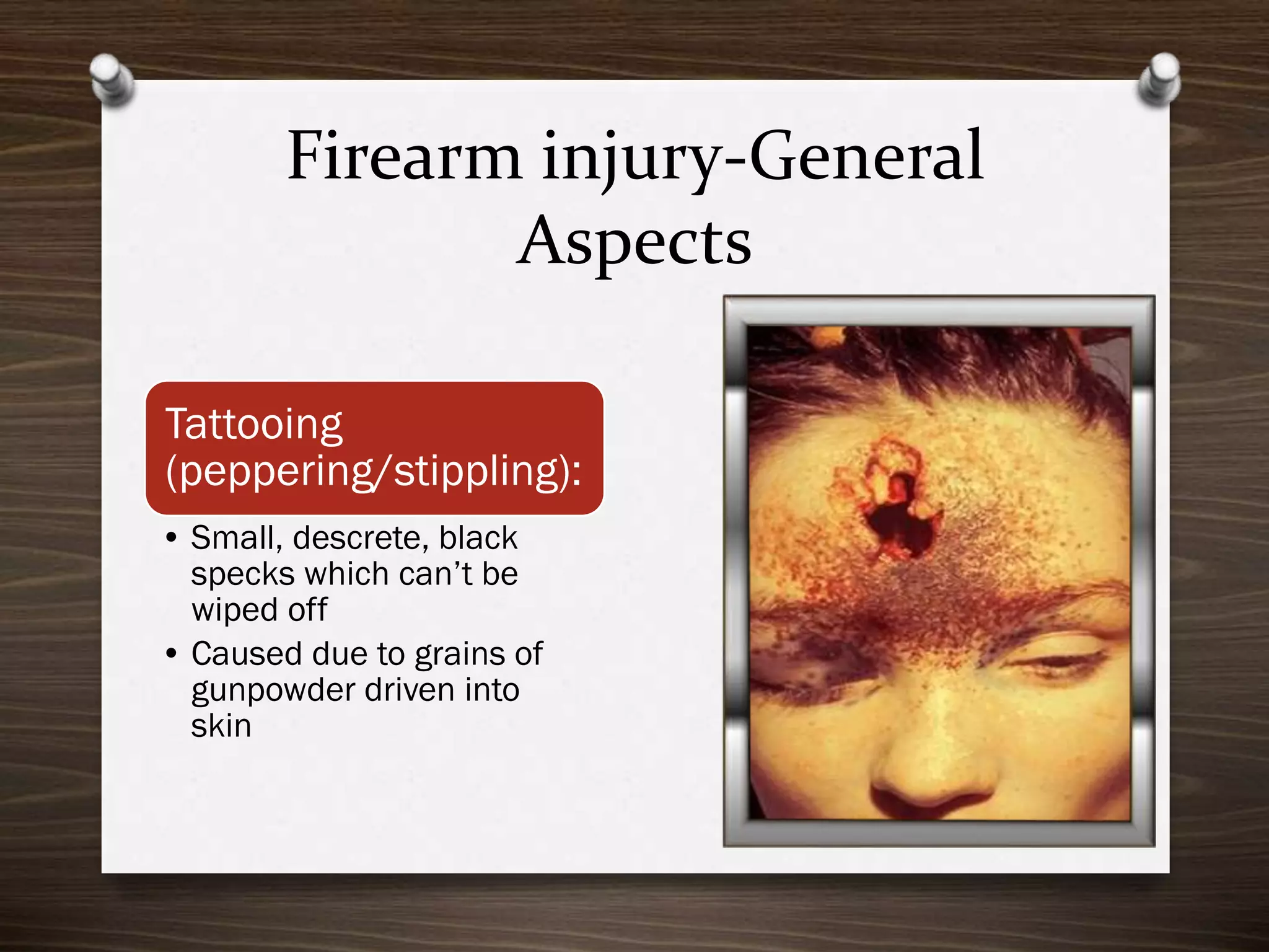 Firearm injury-General
Aspects
Tattooing
(peppering/stippling):
• Small, descrete, black
specks which can’t be
wiped off
• Caused due to grains of
gunpowder driven into
skin

 