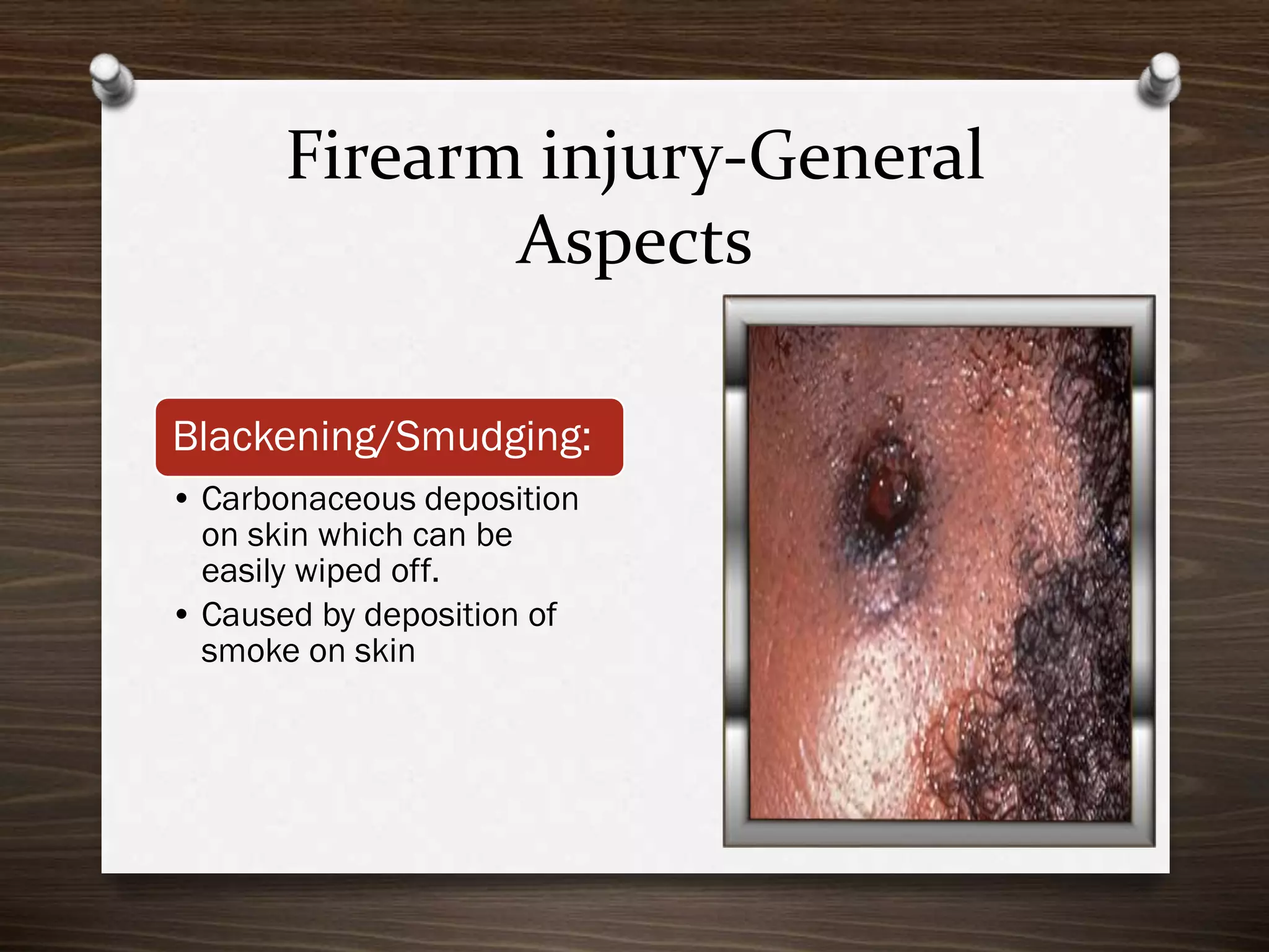 Firearm injury-General
Aspects
Blackening/Smudging:
• Carbonaceous deposition
on skin which can be
easily wiped off.
• Caused by deposition of
smoke on skin

 