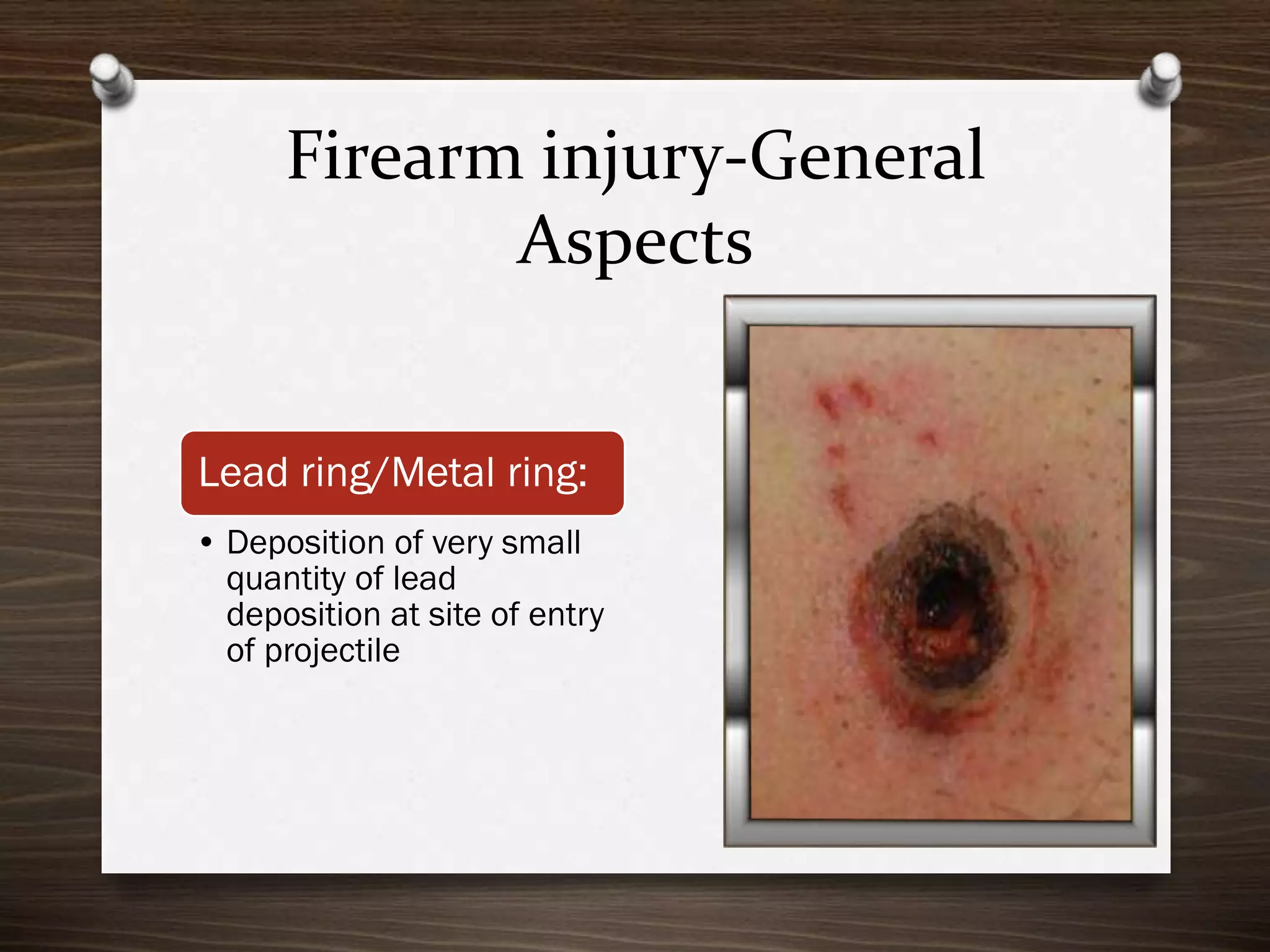 Firearm injury-General
Aspects
Lead ring/Metal ring:
• Deposition of very small
quantity of lead
deposition at site of entry
of projectile

 