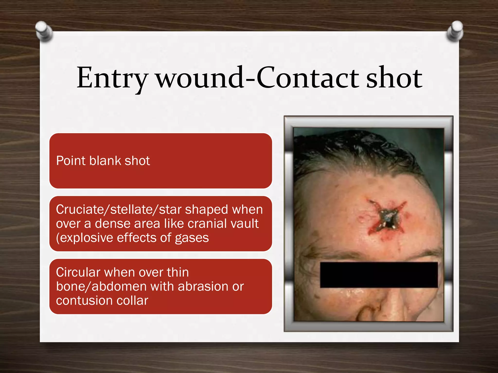 Entry wound-Contact shot
Point blank shot
Cruciate/stellate/star shaped when
over a dense area like cranial vault
(explosive effects of gases
Circular when over thin
bone/abdomen with abrasion or
contusion collar

 