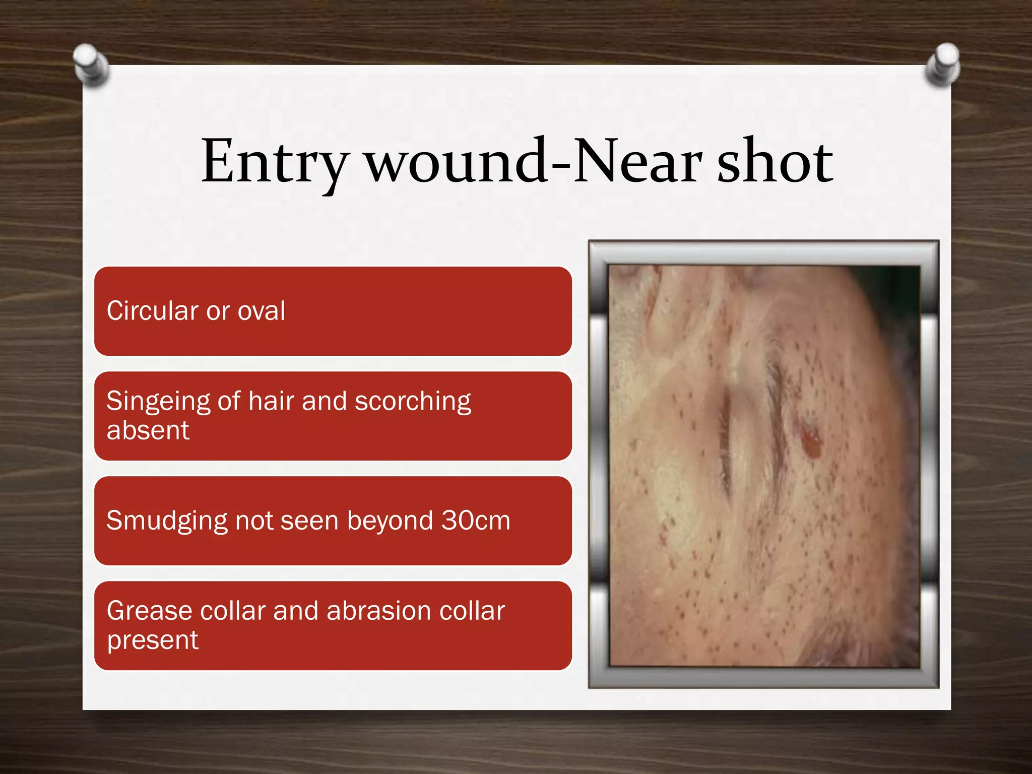 Entry wound-Near shot
Circular or oval

Singeing of hair and scorching
absent
Smudging not seen beyond 30cm
Grease collar and abrasion collar
present

 