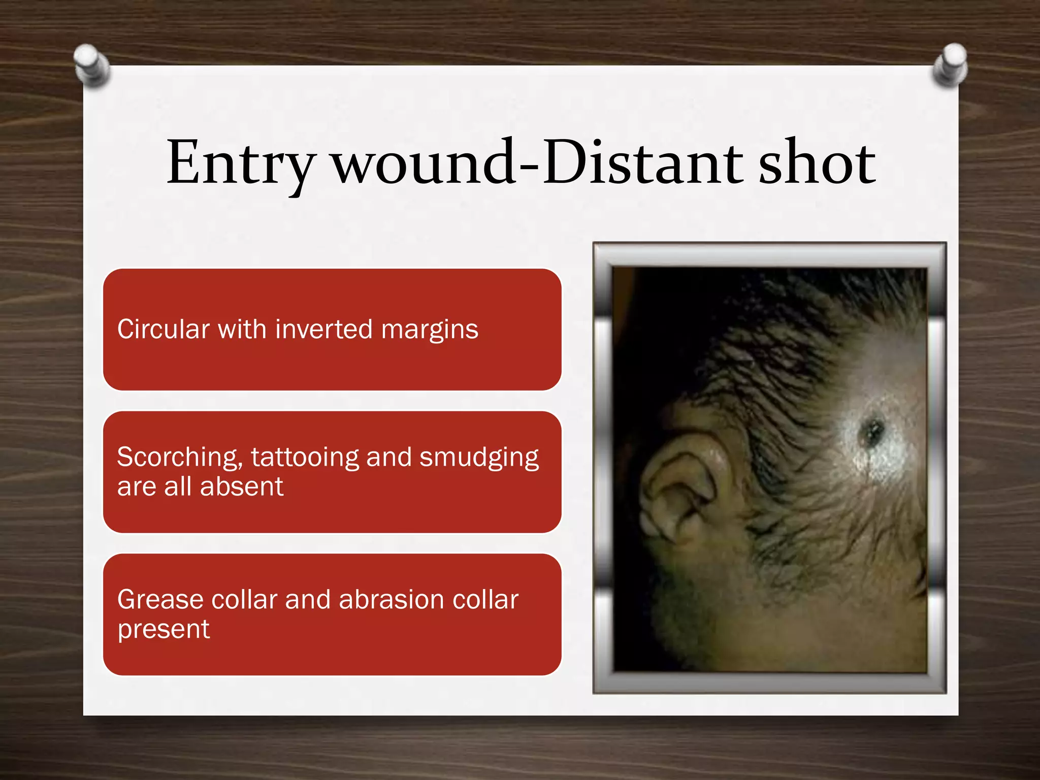 Entry wound-Distant shot
Circular with inverted margins

Scorching, tattooing and smudging
are all absent

Grease collar and abrasion collar
present

 