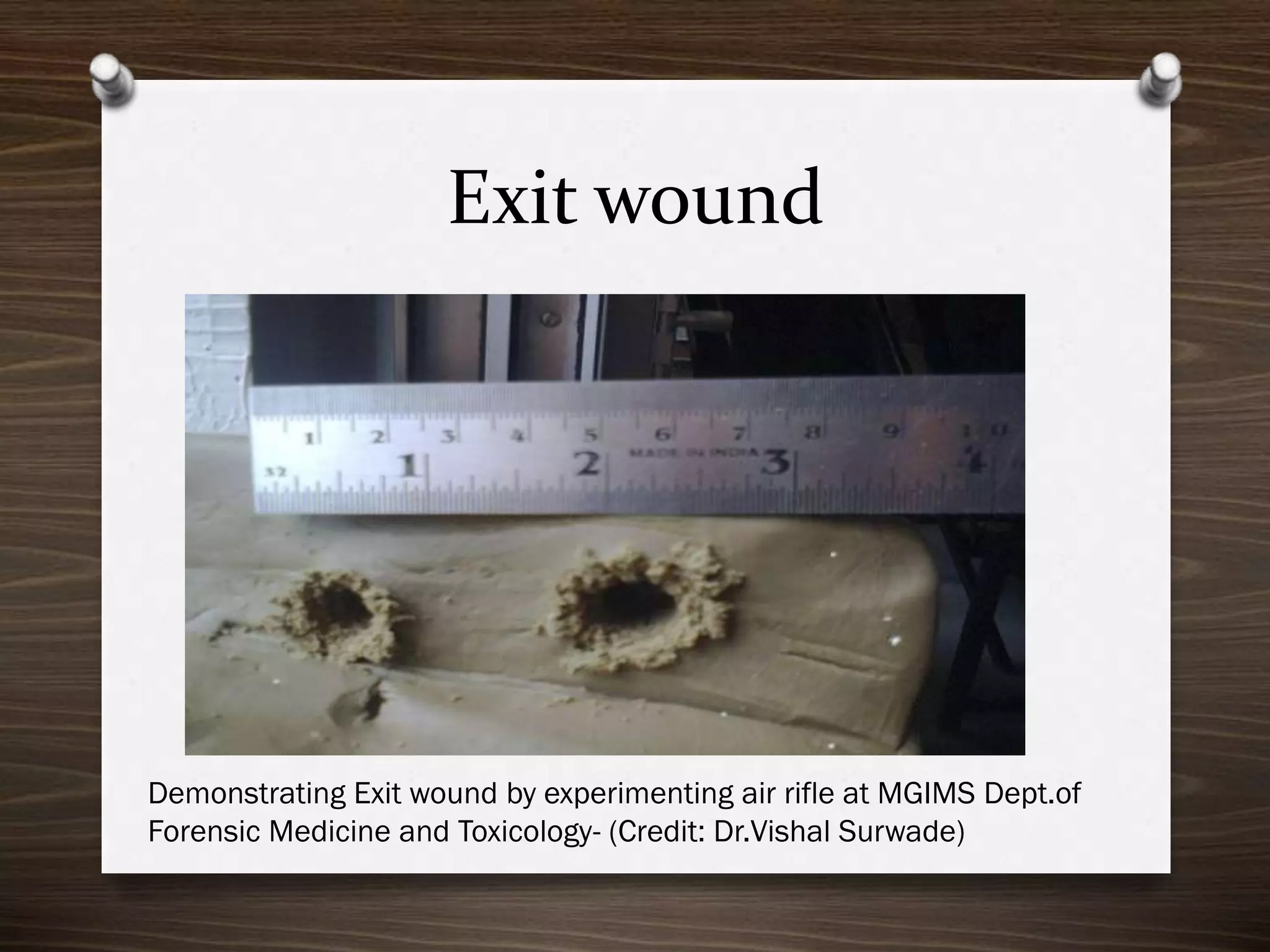 Exit wound

Demonstrating Exit wound by experimenting air rifle at MGIMS Dept.of
Forensic Medicine and Toxicology- (Credit: Dr.Vishal Surwade)

 