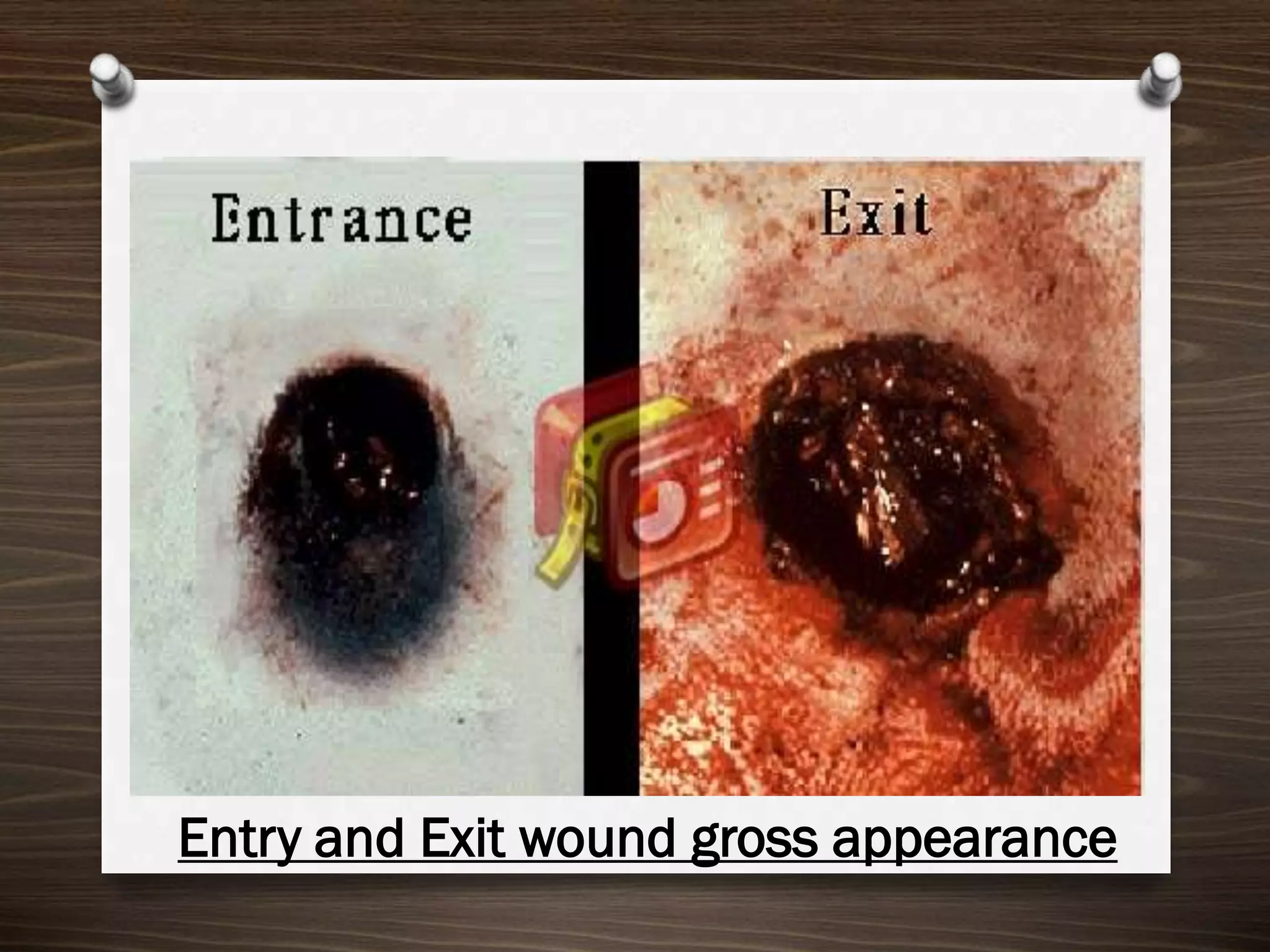 Entry and Exit wound gross appearance

 