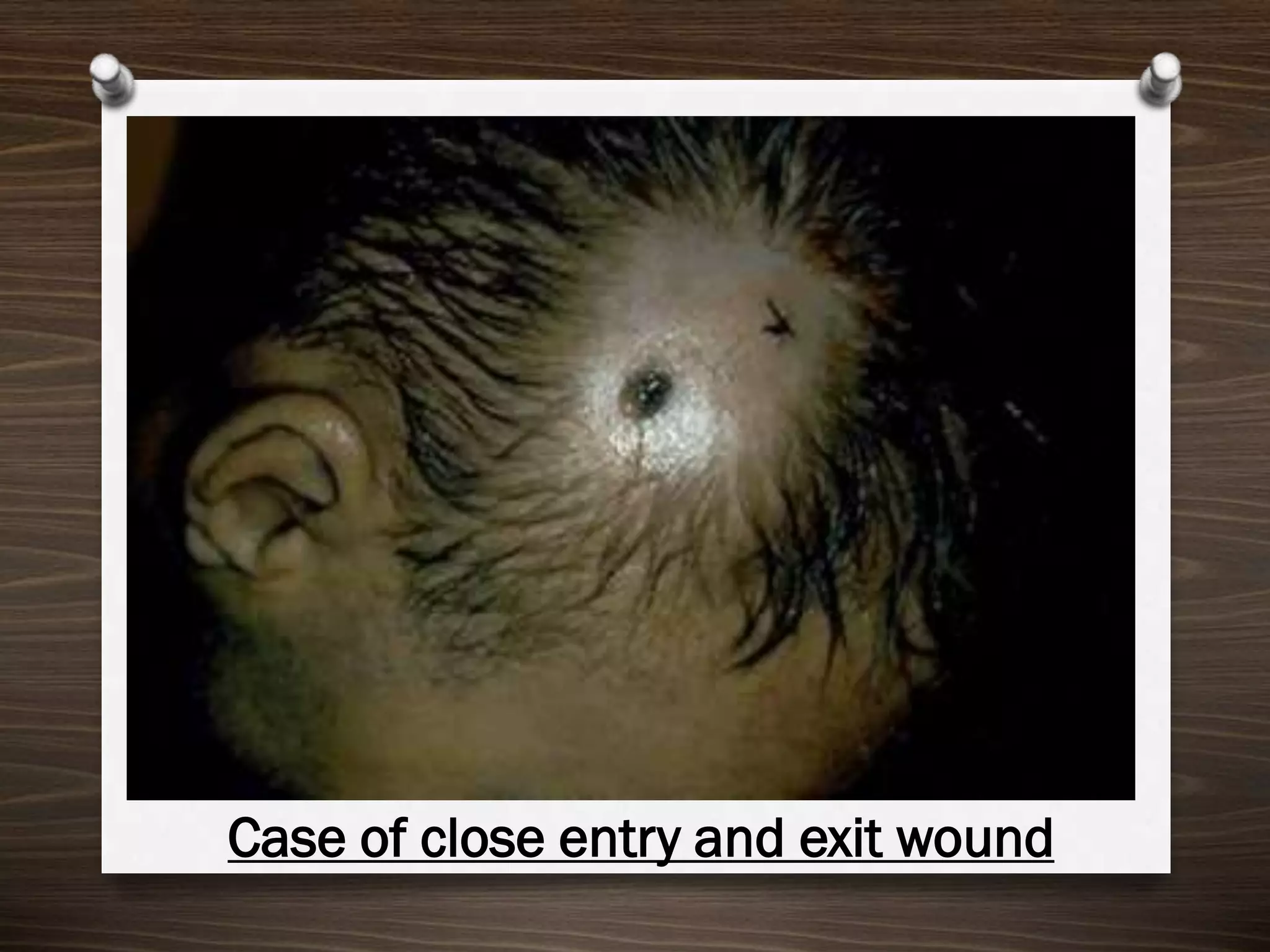 Case of close entry and exit wound

 