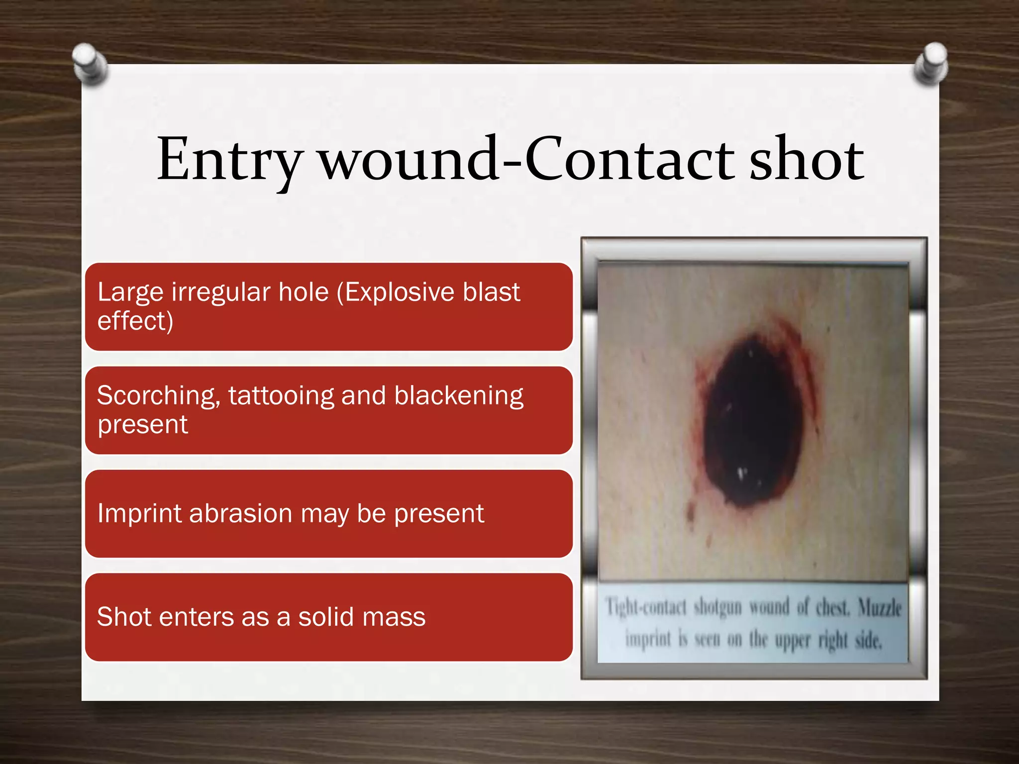 Entry wound-Contact shot
Large irregular hole (Explosive blast
effect)
Scorching, tattooing and blackening
present
Imprint abrasion may be present

Shot enters as a solid mass

 