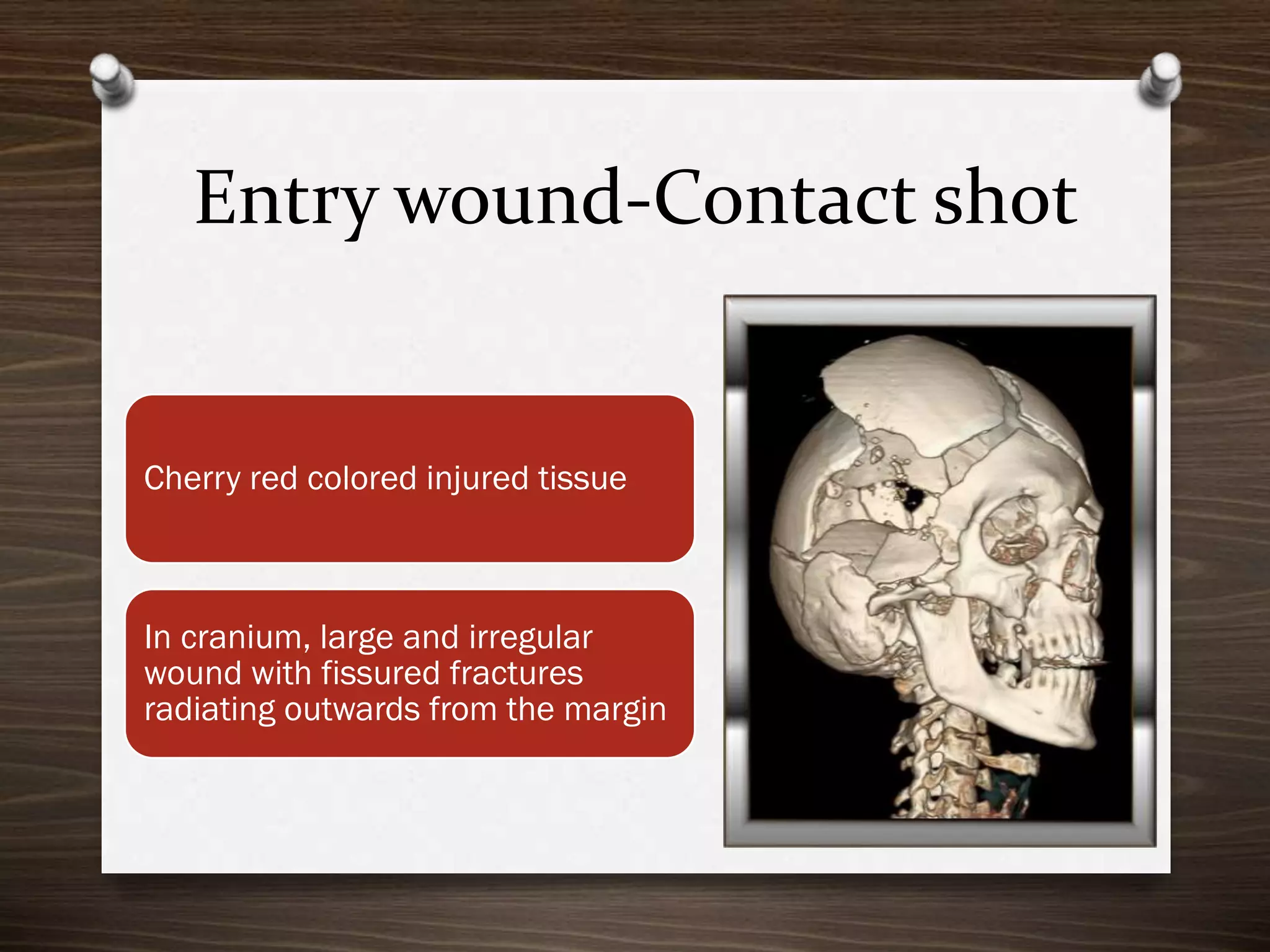 Entry wound-Contact shot

Cherry red colored injured tissue

In cranium, large and irregular
wound with fissured fractures
radiating outwards from the margin

 