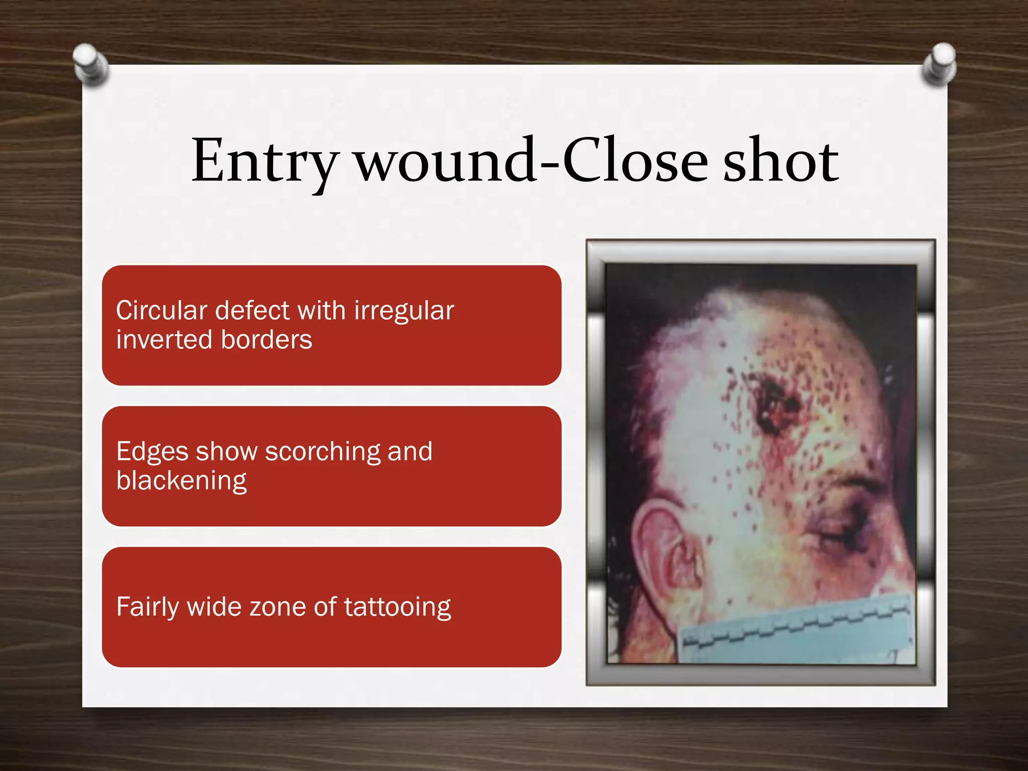 Entry wound-Close shot
Circular defect with irregular
inverted borders

Edges show scorching and
blackening

Fairly wide zone of tattooing

 