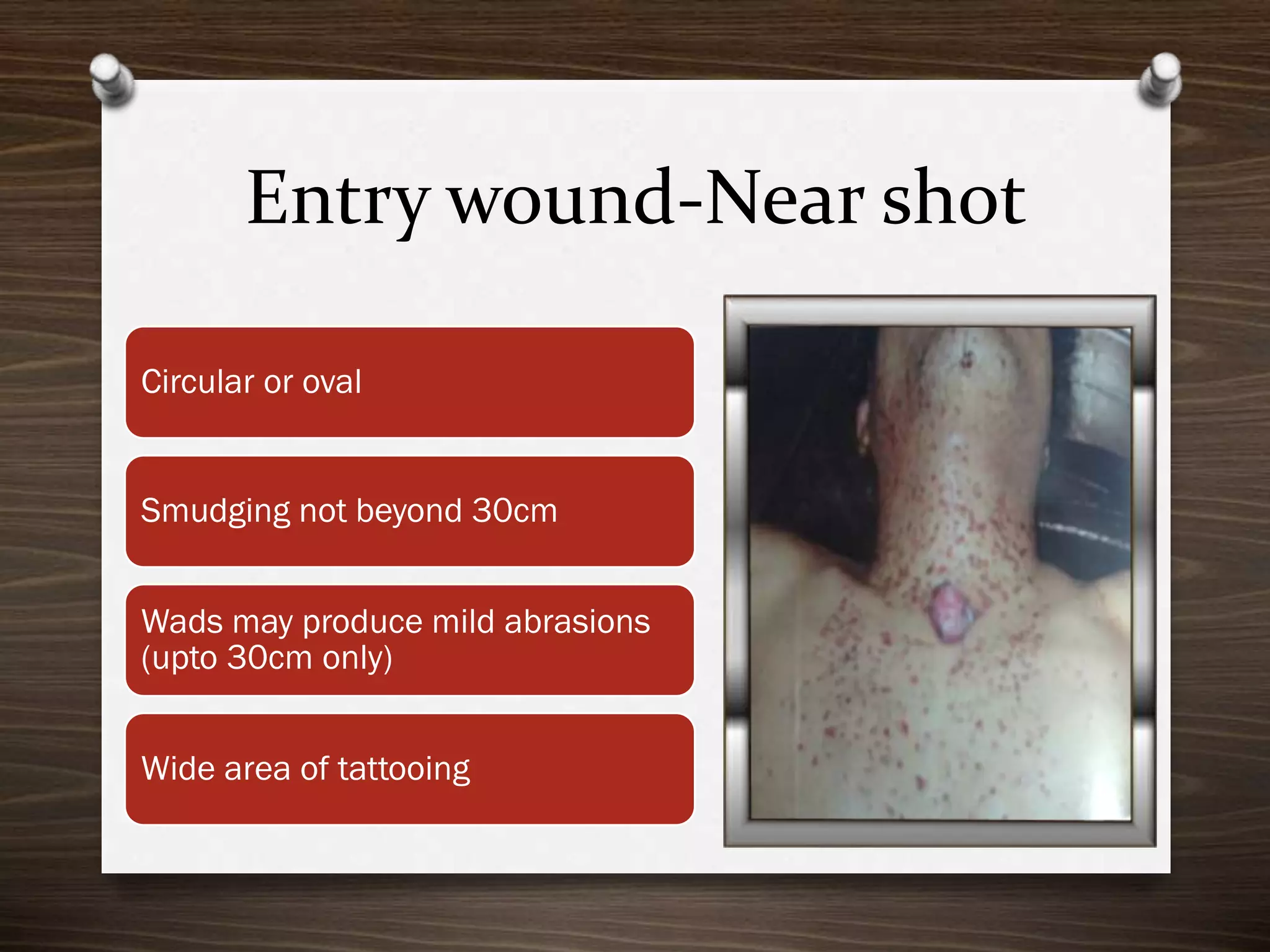 Entry wound-Near shot
Circular or oval

Smudging not beyond 30cm
Wads may produce mild abrasions
(upto 30cm only)
Wide area of tattooing

 