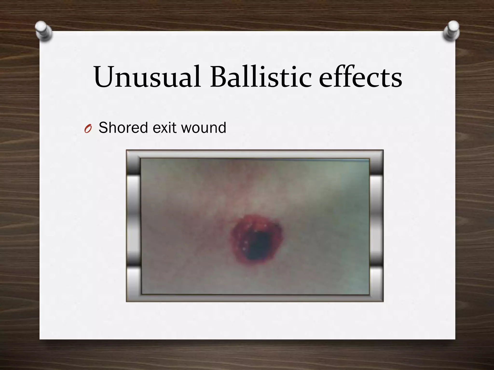 Unusual Ballistic effects
O Shored exit wound

 