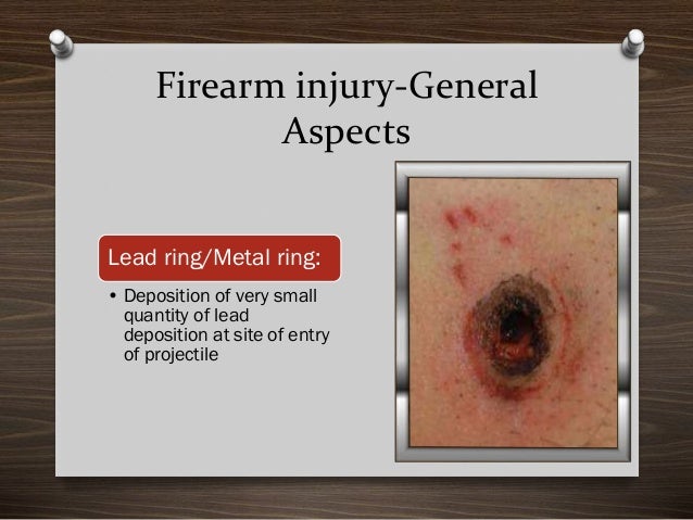 Location Of Wounds In Self Inflicted Firearm Injuries