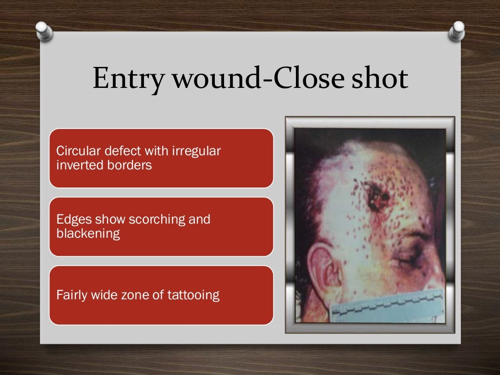 Firearm injuries_Forensics