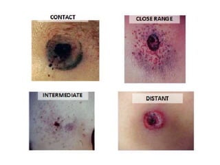 Firearm injuries | PPTX