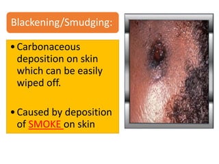 Blackening/Smudging:
•Carbonaceous
deposition on skin
which can be easily
wiped off.
•Caused by deposition
of SMOKE on skin
 