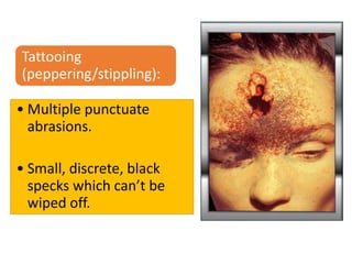 Tattooing
(peppering/stippling):
• Multiple punctuate
abrasions.
• Small, discrete, black
specks which can’t be
wiped off.
 