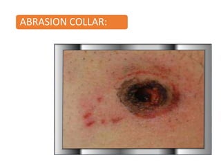 ABRASION COLLAR:
 