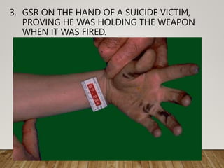 3. GSR ON THE HAND OF A SUICIDE VICTIM,
PROVING HE WAS HOLDING THE WEAPON
WHEN IT WAS FIRED.
 
