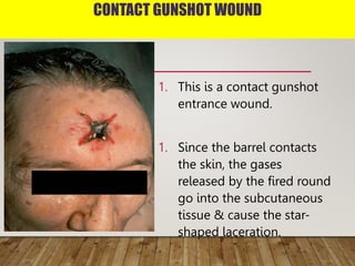 CONTACT GUNSHOT WOUND
1. This is a contact gunshot
entrance wound.
1. Since the barrel contacts
the skin, the gases
released by the fired round
go into the subcutaneous
tissue & cause the star-
shaped laceration.
 