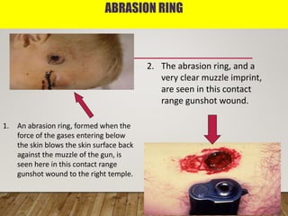 ABRASION RING
1. An abrasion ring, formed when the
force of the gases entering below
the skin blows the skin surface back
against the muzzle of the gun, is
seen here in this contact range
gunshot wound to the right temple.
2. The abrasion ring, and a
very clear muzzle imprint,
are seen in this contact
range gunshot wound.
 