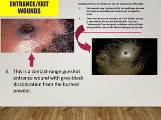 ENTRANCE/EXIT
WOUNDS
3. This is a contact range gunshot
entrance wound with grey-black
discoloration from the burned
powder.
Displayed here is an entrance at the left and an exit at the right.
1. Exit wounds vary considerably in size and shape because
the bullet can be deformed in its transit through the
body.
2. There may be no exit wound at all if the bullet's energy
is absorbed by the tissues. Some bullets (such as a
"hollow point") are designed to deform so that all their
energy will be converted to tissue damage and not exit.
 