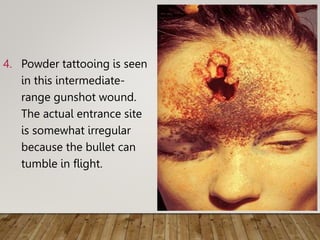 4. Powder tattooing is seen
in this intermediate-
range gunshot wound.
The actual entrance site
is somewhat irregular
because the bullet can
tumble in flight.
 