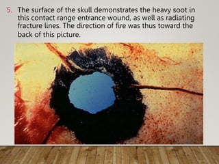 5. The surface of the skull demonstrates the heavy soot in
this contact range entrance wound, as well as radiating
fracture lines. The direction of fire was thus toward the
back of this picture.
 
